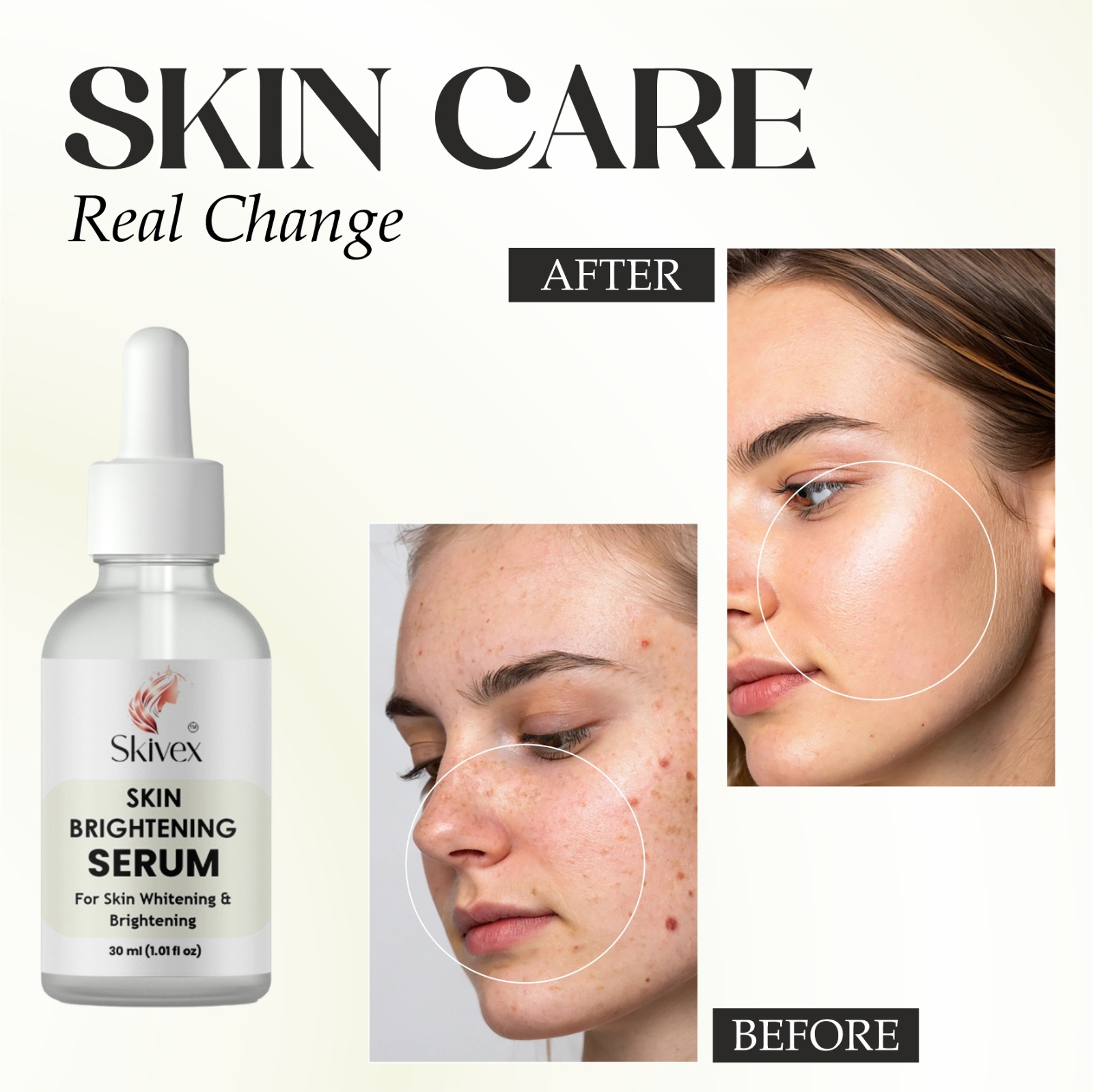 Niacinamide Serum for Acne Marks, Blemishes & Hyperpigmentation – Oil Control & Skin Brightening 30ml | Skivex