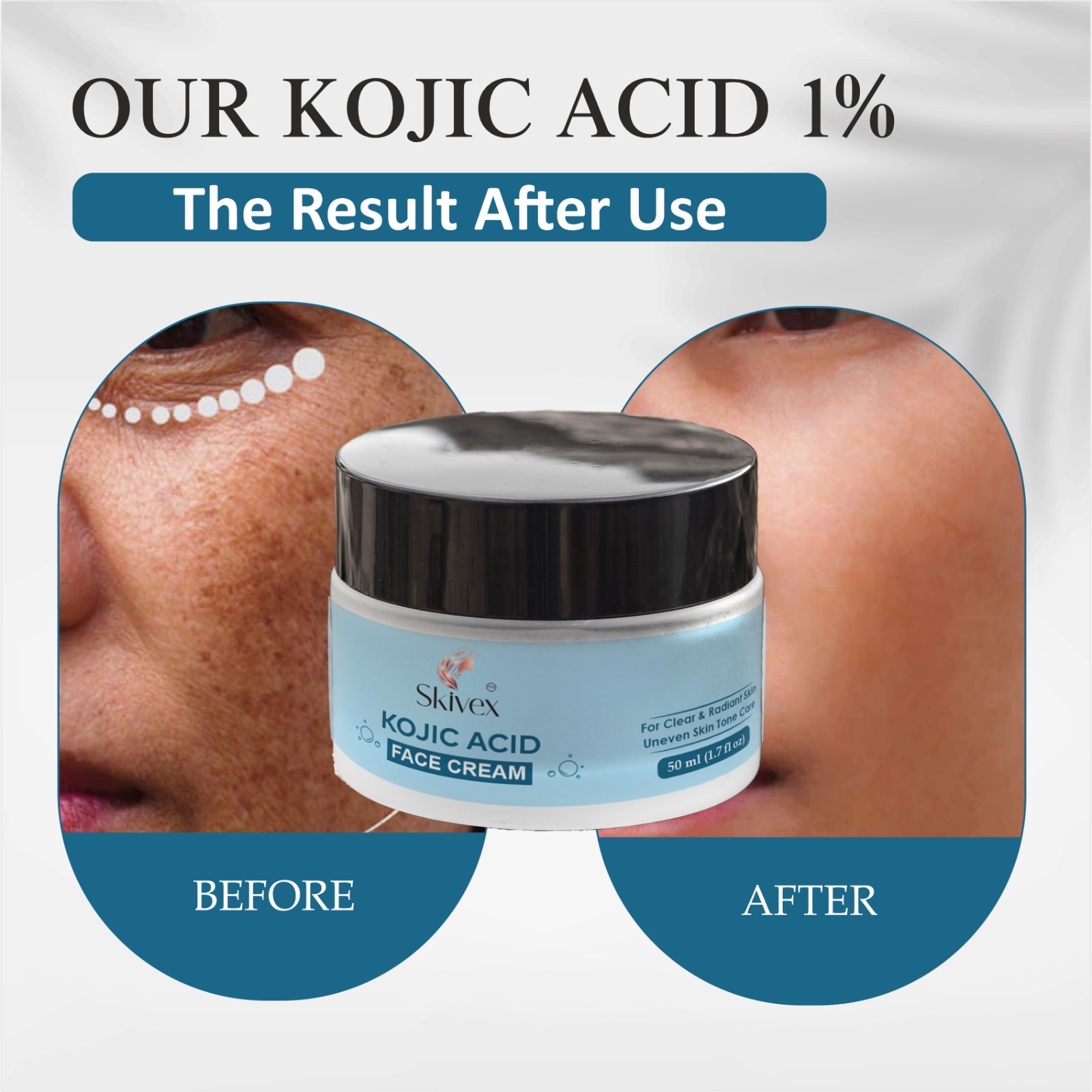Kojic Acid Face Cream with Niacinamide & Alpha Arbutin for Hyperpigmentation, Dark Spots & Brightening – 50ml | Skivex