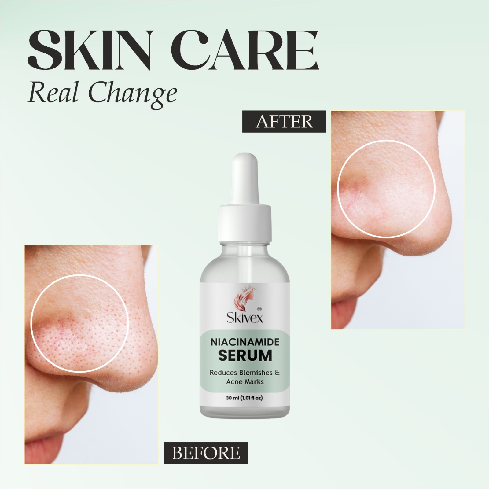 Niacinamide Serum for Acne Marks, Blemishes & Hyperpigmentation – Oil Control & Skin Brightening 30ml | Skivex