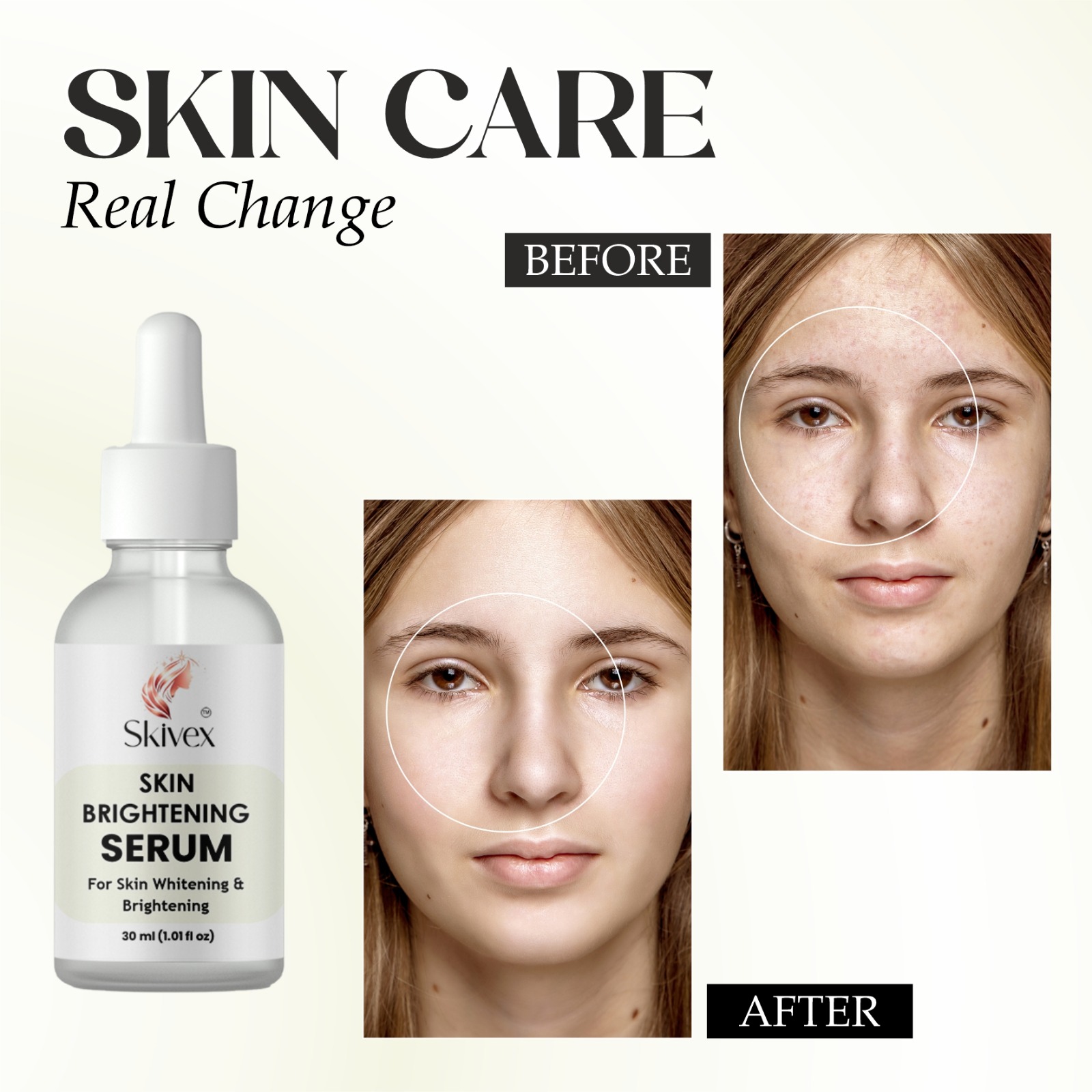 Niacinamide Serum for Acne Marks, Blemishes & Hyperpigmentation – Oil Control & Skin Brightening 30ml | Skivex