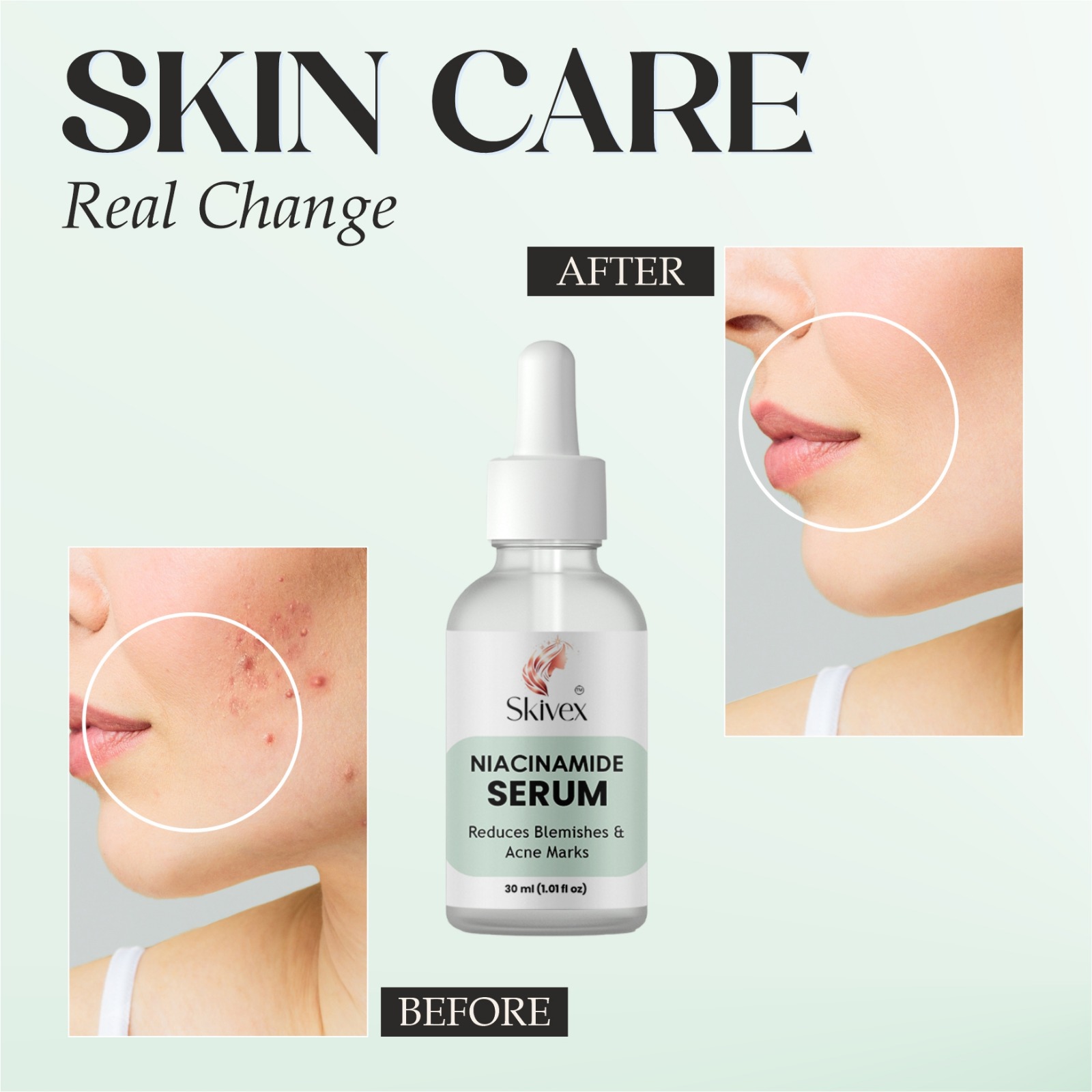 Niacinamide Serum for Acne Marks, Blemishes & Hyperpigmentation – Oil Control & Skin Brightening 30ml | Skivex