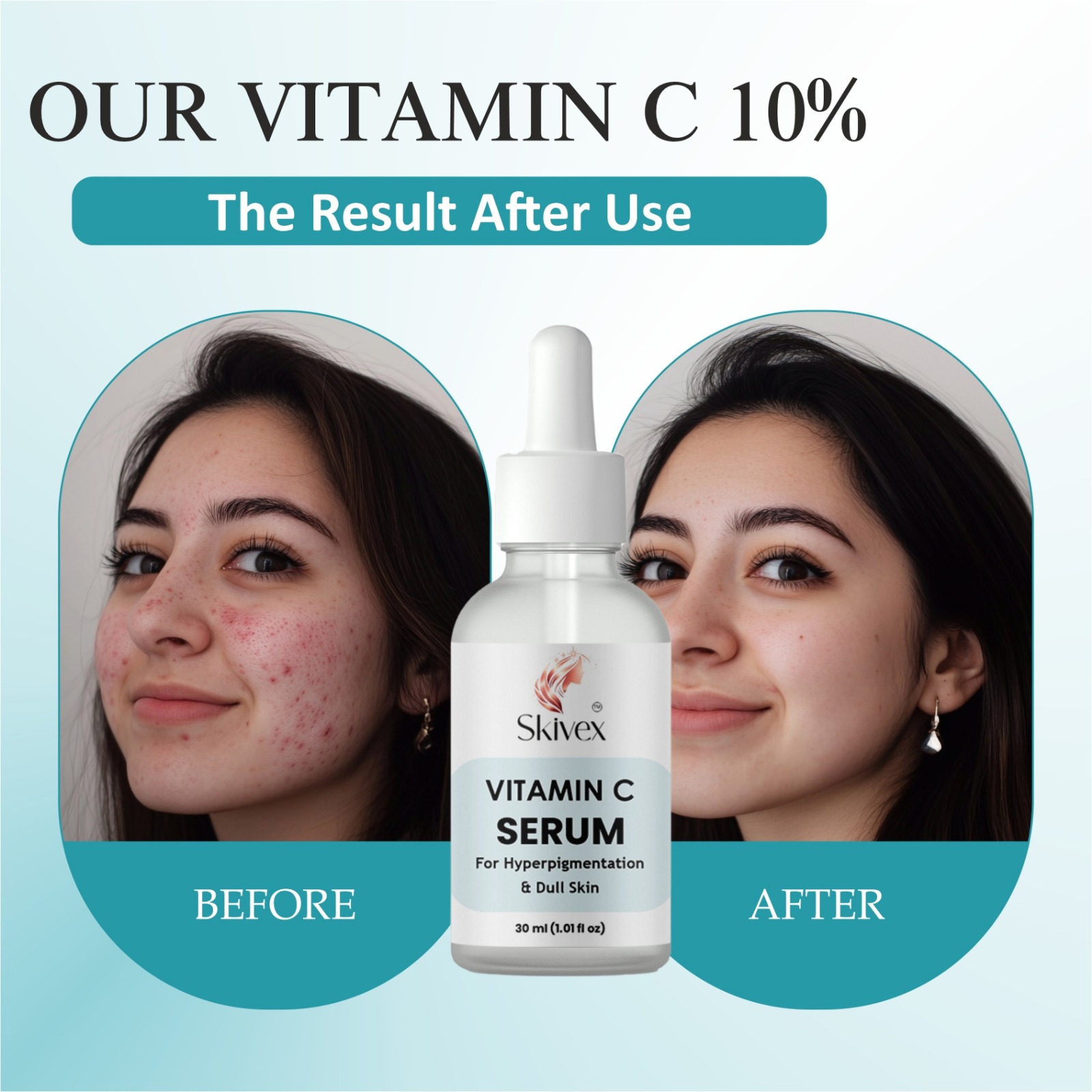 Skivex Alpha Arbutin 2% Face Serum for Dark Spots, Pigmentation & Brightening – 30ml